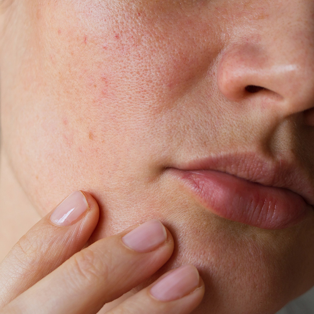 Komplet Hudguide Hvilken Hudtype Har Jeg 1000X1000px Ny